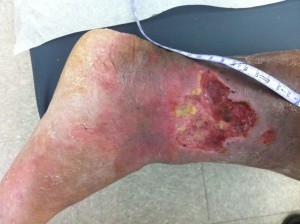 Chronic Ankle Ulcer