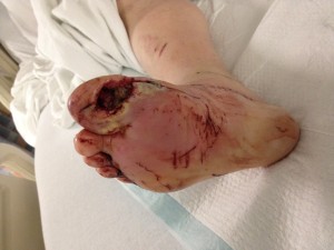 Diabetic Foot Ulcer