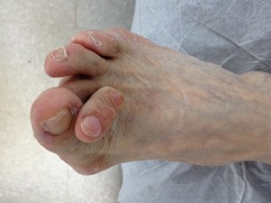 Foot Deformity