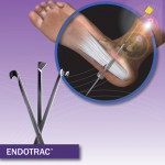 Endoscopic Plantar Fasciotomy